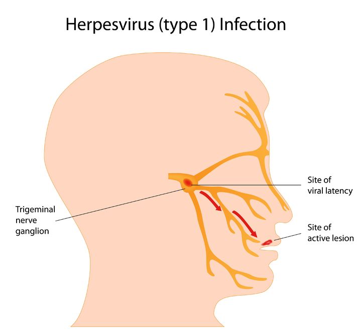 Virus del Herpes Simple: HSV-1 y HSV-2